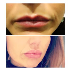 Lip fillers at La Suite Beauty Aesthetics Salon in Corbridge Northumberland 1